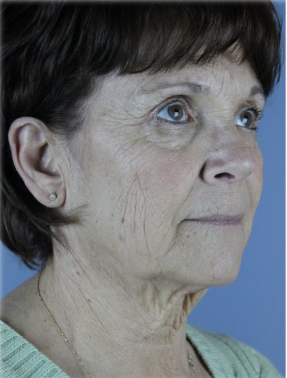 QuickLift Before & After Patient #5633