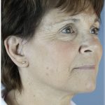 QuickLift Before & After Patient #5633