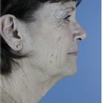 QuickLift Before & After Patient #5633
