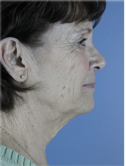 QuickLift Before & After Patient #5633