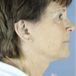 QuickLift Before & After Patient #5633