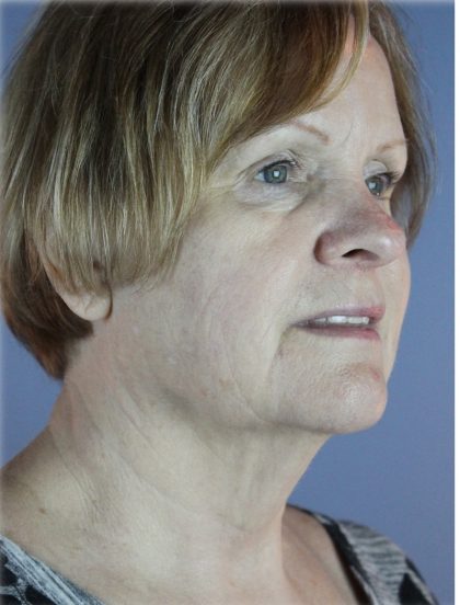 QuickLift Before & After Patient #5645