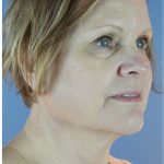 QuickLift Before & After Patient #5645