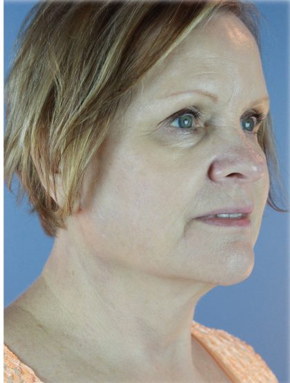 QuickLift Before & After Patient #5645