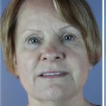 QuickLift Before & After Patient #5645