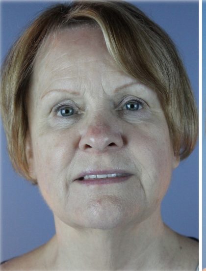 QuickLift Before & After Patient #5645