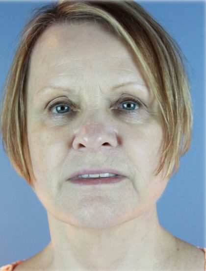 QuickLift Before & After Patient #5645