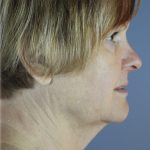 QuickLift Before & After Patient #5645