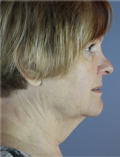 QuickLift Before & After Patient #5645
