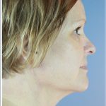 QuickLift Before & After Patient #5645