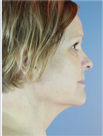 QuickLift Before & After Patient #5645