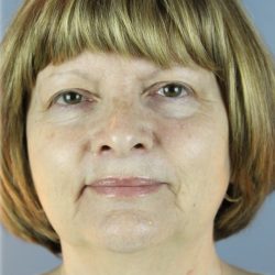 QuickLift Before & After Patient #5662