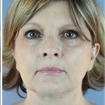 QuickLift Before & After Patient #5662