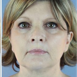 QuickLift Before & After Patient #5662