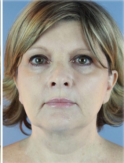 QuickLift Before & After Patient #5662