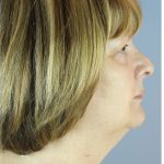 QuickLift Before & After Patient #5662