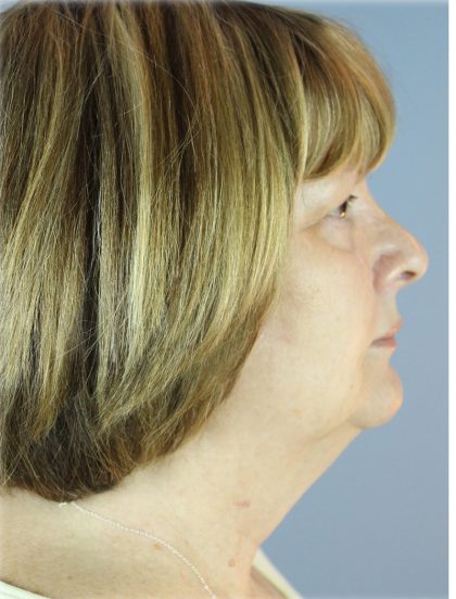 QuickLift Before & After Patient #5662