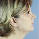 QuickLift Before & After Patient #5662