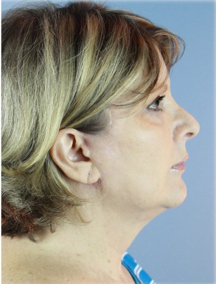 QuickLift Before & After Patient #5662