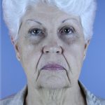 QuickLift Before & After Patient #5673