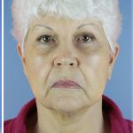 QuickLift Before & After Patient #5673