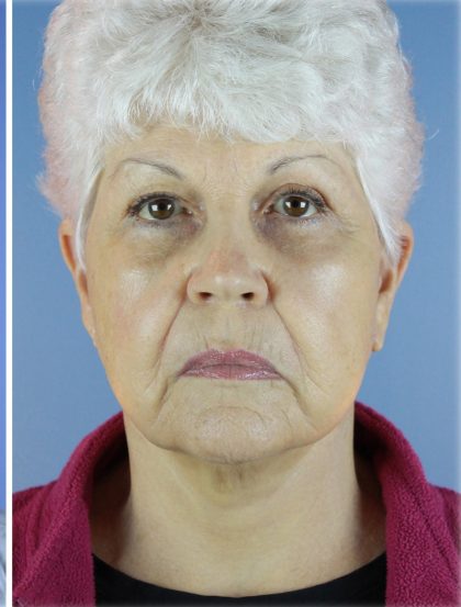 QuickLift Before & After Patient #5673