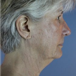 QuickLift Before & After Patient #5680
