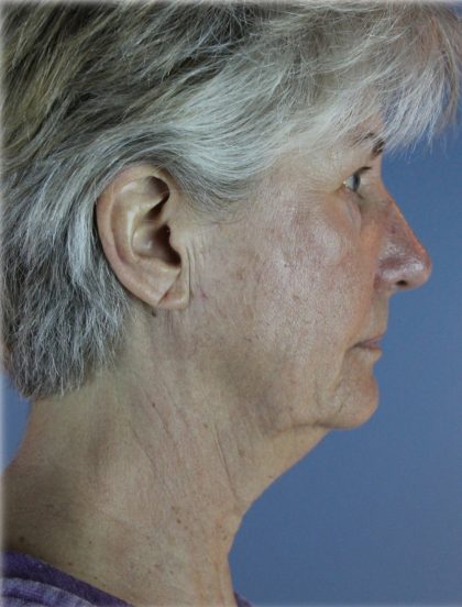 QuickLift Before & After Patient #5680