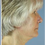 QuickLift Before & After Patient #5680