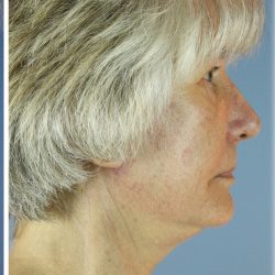 QuickLift Before & After Patient #5680