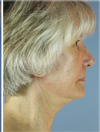 QuickLift Before & After Patient #5680