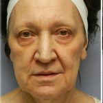 Fat Grafting Before & After Patient #5173