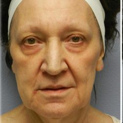 Fat Grafting Before & After Patient #5173