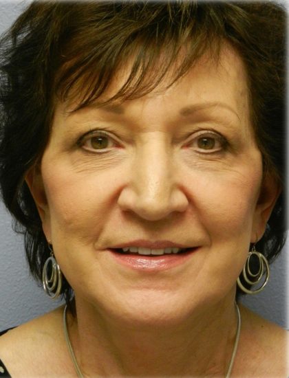 Fat Grafting Before & After Patient #5173