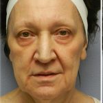 QuickLift Before & After Patient #5689