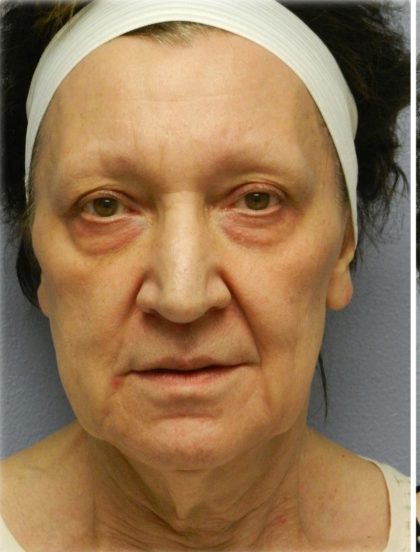 QuickLift Before & After Patient #5689