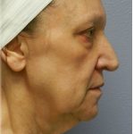 Fat Grafting Before & After Patient #5173