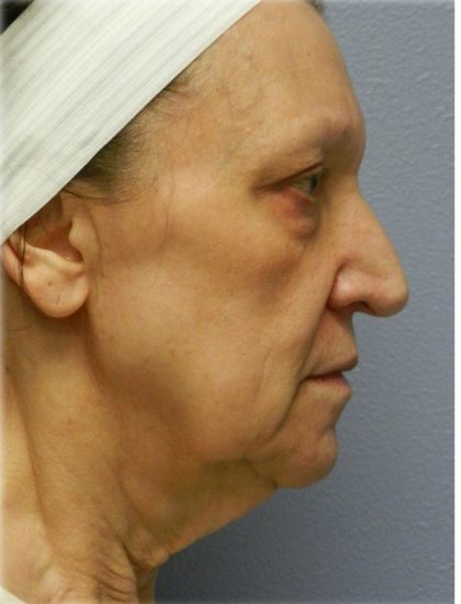 Fat Grafting Before & After Patient #5173