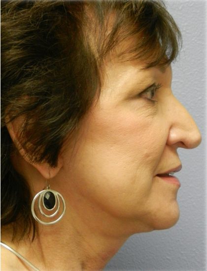 Fat Grafting Before & After Patient #5173