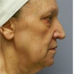 QuickLift Before & After Patient #5689