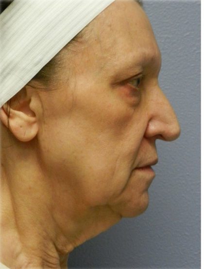 QuickLift Before & After Patient #5689