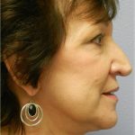 QuickLift Before & After Patient #5689