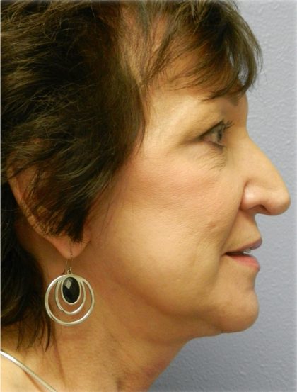 QuickLift Before & After Patient #5689