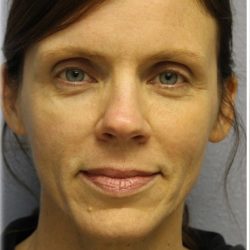 Fat Grafting Before & After Patient #5185