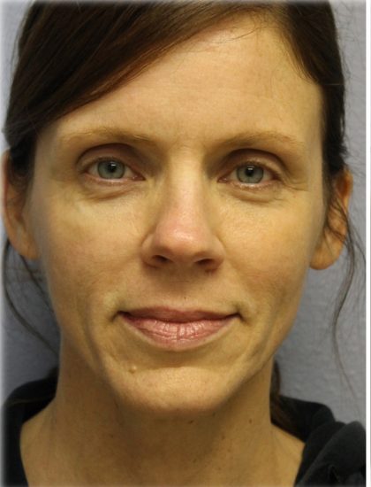 Fat Grafting Before & After Patient #5185