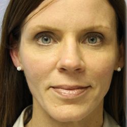 Fat Grafting Before & After Patient #5185