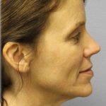 Fat Grafting Before & After Patient #5185