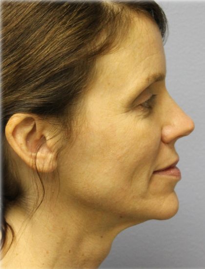 Fat Grafting Before & After Patient #5185