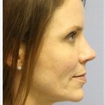 Fat Grafting Before & After Patient #5185