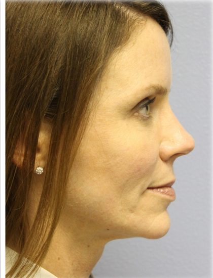 Fat Grafting Before & After Patient #5185